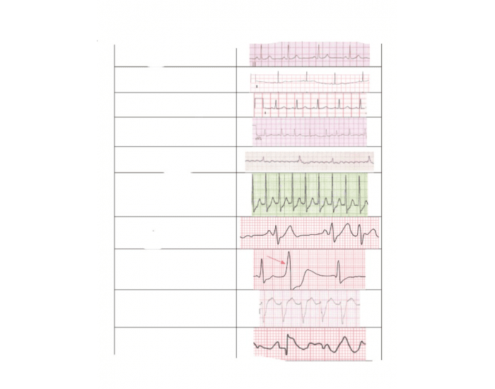 ECG Interpretations Quiz