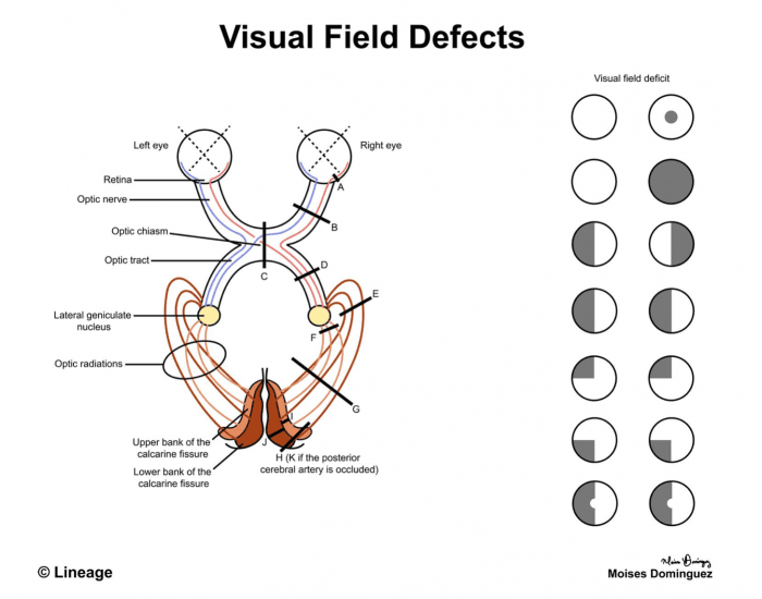Visual field defects — Printable Worksheet