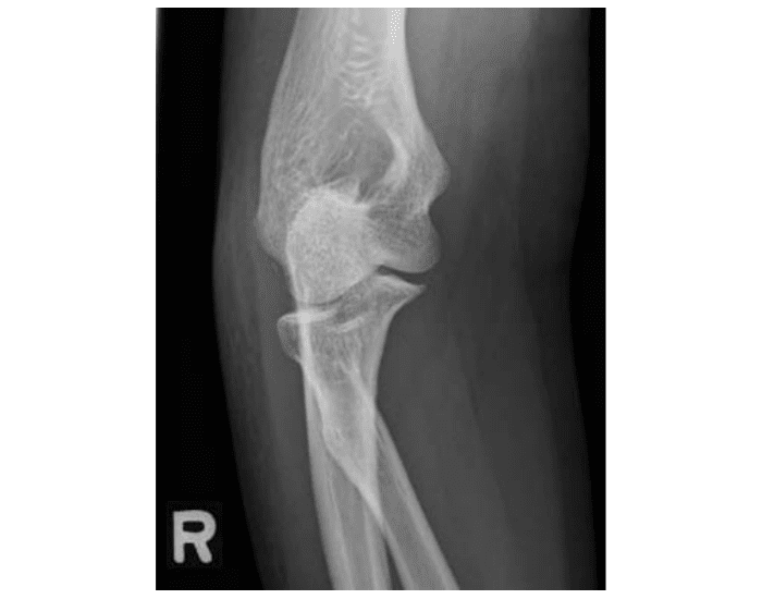 AP Oblique elbow medial rotation Quiz
