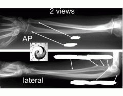 Projection Types Radiography forearm radiograph