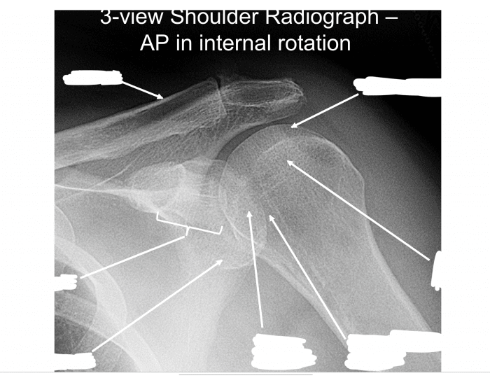 Shoulder Radiograph - AP in internal rotation — Printable Worksheet