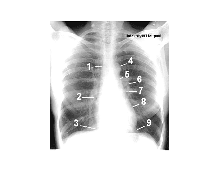 Mediastinal contours Quiz