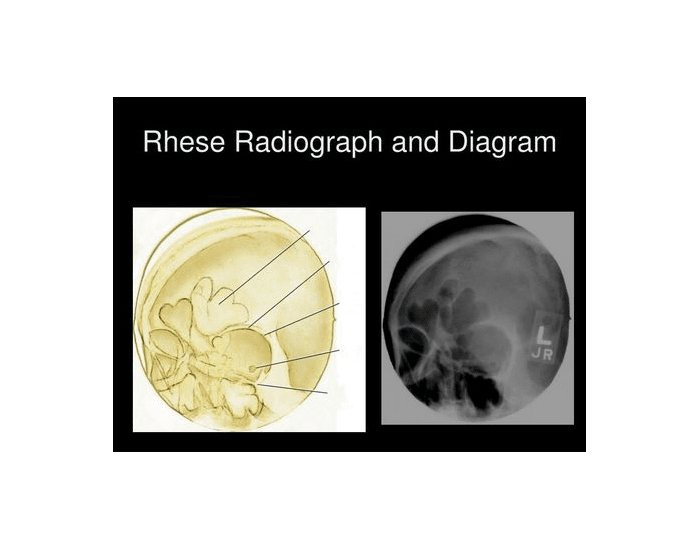 Reverse Rhese Method Rhese diagram Quiz