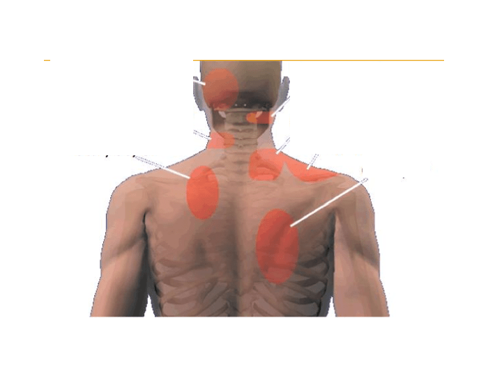 C4 Referral Pattern C-Spine Referral patterns Quiz