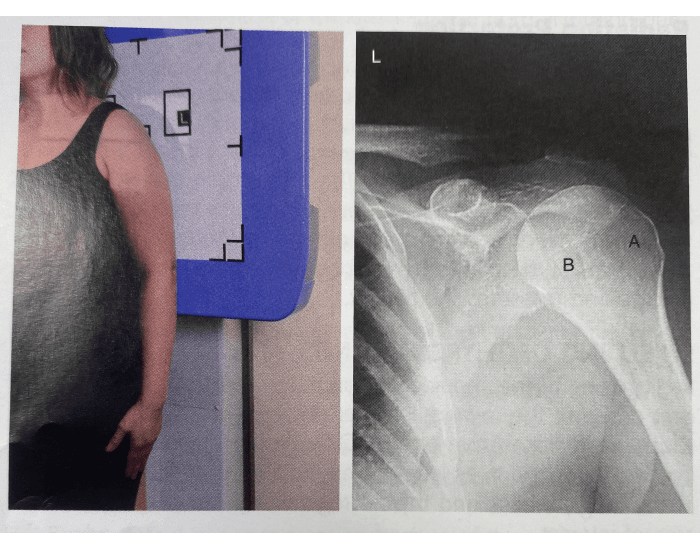 Neutral rotation: Shoulder Quiz