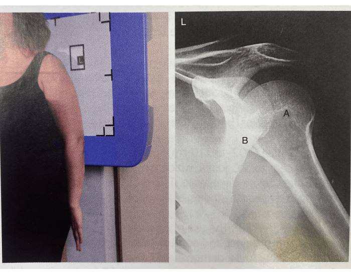 Shoulder Internal Rotation Radiography Positioning Internal rotation - Shoulder Quiz
