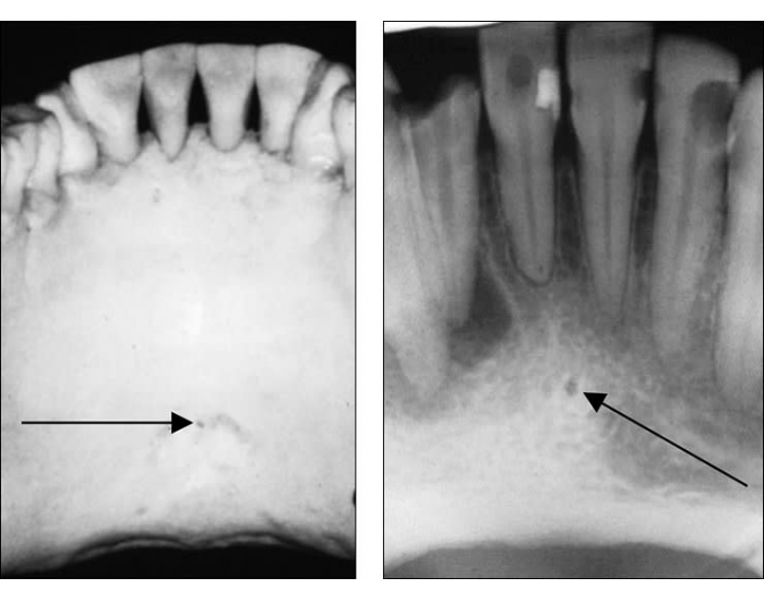 radiographie géniale du tubercule