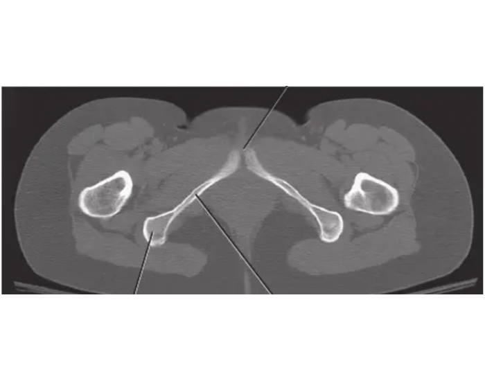 Axial CT of inferior pubic ramus Quiz