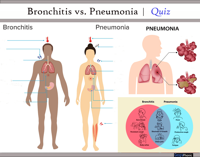 Bronchitis vs Pneumonia | Quiz