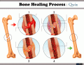 Bone Healing Process in 4 stages  | Quiz