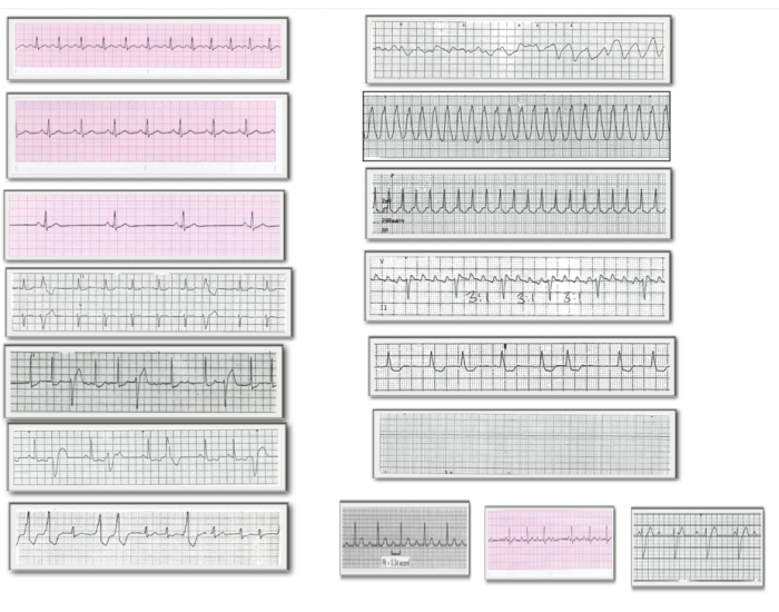 Heart Dysrhythmias Printable Worksheet