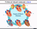 Types of Heart Disease 