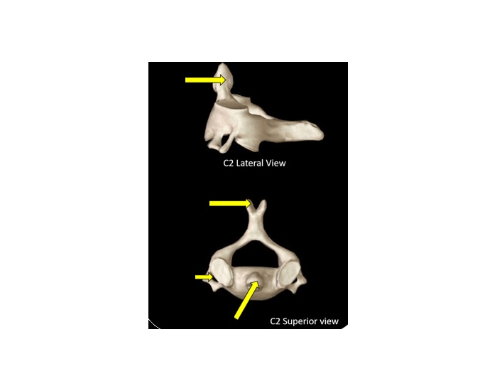 6.13 Cervical Vertebrae C2 (Axis) Quiz