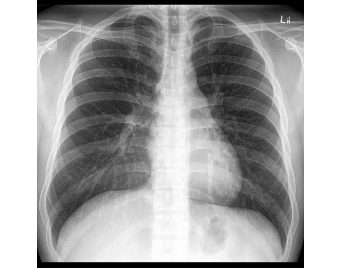 Chest Radiograph Radiopaedia Chest X-Ray Anatomy. (Radiopaedia image) — Printable Worksheet