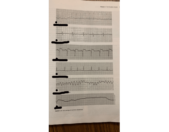 Common ECG Tracings Printable Worksheet
