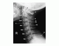 Spine X Ray