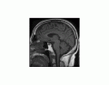 Sagittal T1 MRI Brain