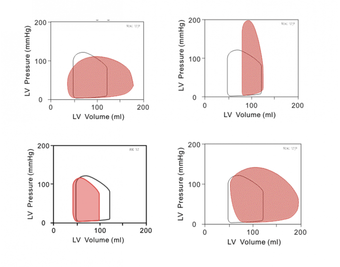 Pressure Volume Loops: Valvular Problems — Printable Worksheet