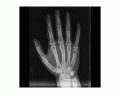 Identify The Fracture Hand X-Ray-Radiopaedia Image