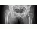 Identify The Fracture- Pelvis/Hip/NOF X-Ray