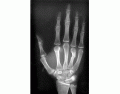 Identify The Fracture- Hand X-Ray (AAOS Image)