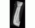 Identify The Fracture- Forearm Anatomy X-Ray 