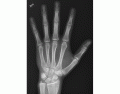 Hand X-ray Anatomy (Wikipedia Image)