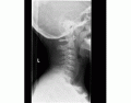 C-Spine Lateral X-Ray Anatomy (Radiopaedia Image)
