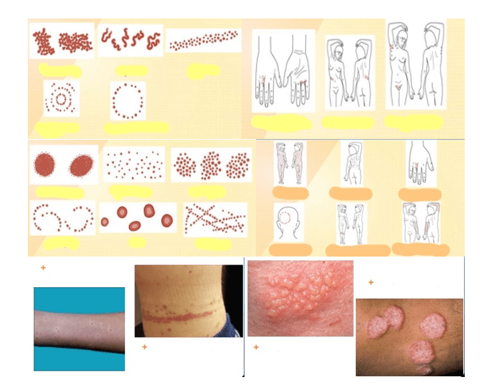 Grouped Lesion Pattern Lesions: patterns and distributions Quiz