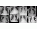 Chest Pathology X rays 