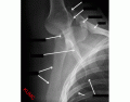 Abducted Shoulder X ray