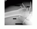 Axial Shoulder X Ray