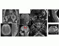 MRI artifact images