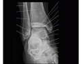 Ankle X ray