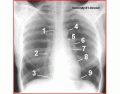 Mediastinum x ray