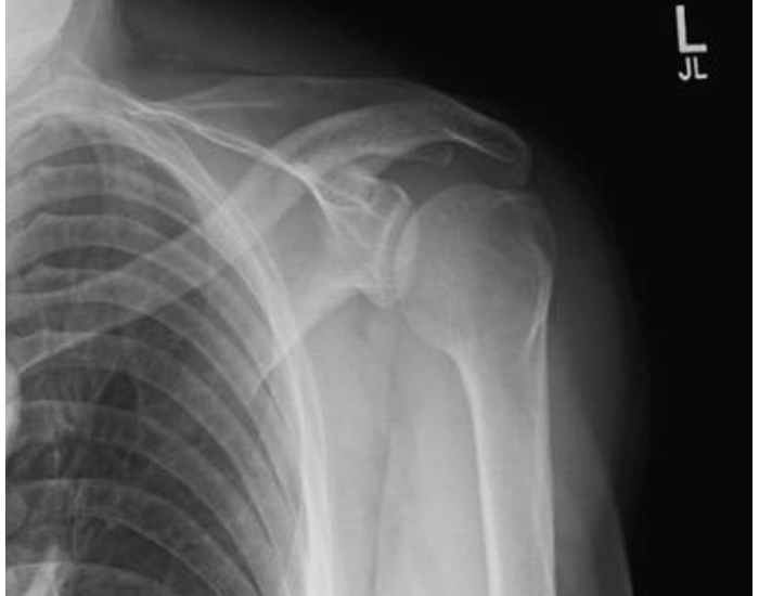 Apical AP axial of the shoulder — Printable Worksheet