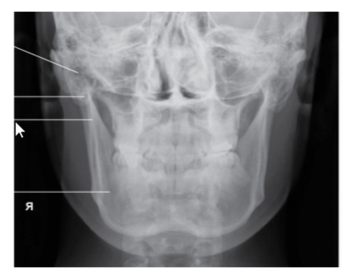 pa mandible rami Quiz