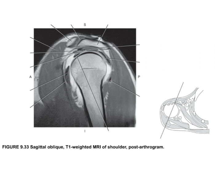 Labeled Sholder Anthrogram Week12 Sagittal oblique Shoulder, post-Arthrogram Quiz
