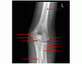 AP Elbow X-Ray Anatomy