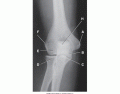 AP Elbow X-Ray Anatomy (Quizlet Image)