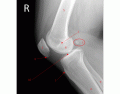 Lateral Knee X-Ray Anatomy