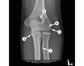 AP Elbow X-Ray Anatomy (Radiopaedia Image)