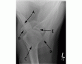 Axial Shoulder X-Ray Anatomy (BMJ Image)