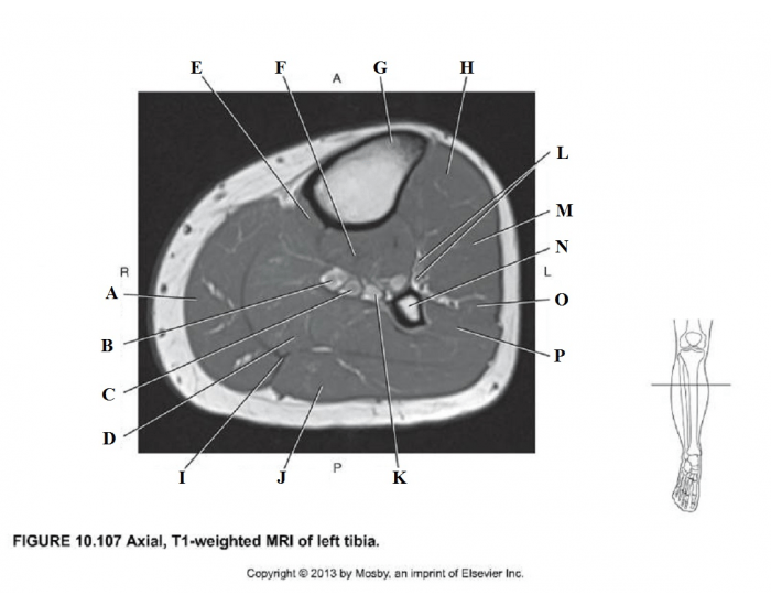 Axial View Tibia Axial of left tibia Quiz