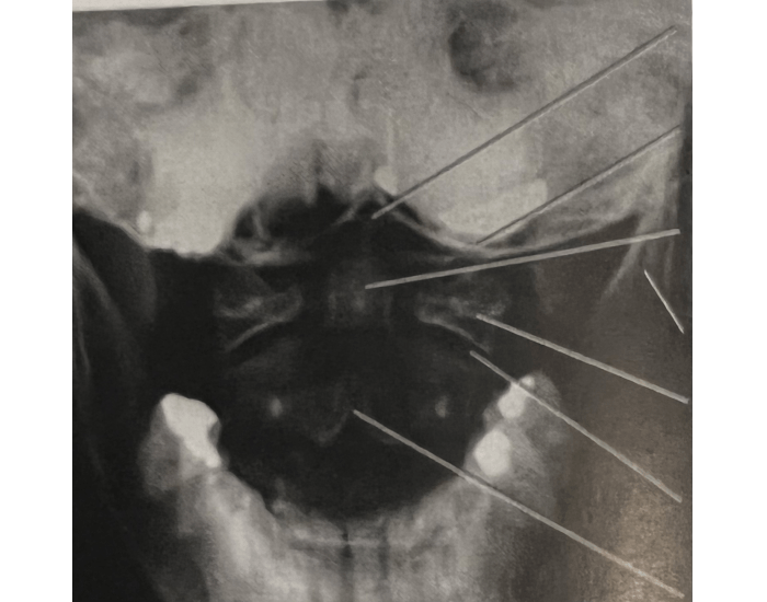 Open mouth atlas and axis Quiz