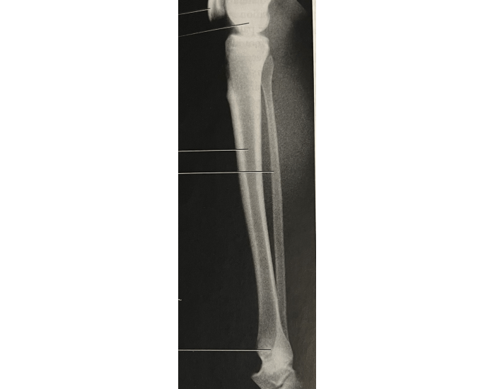 Lateral tib/fib Quiz