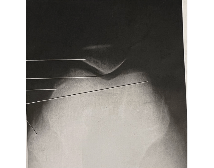Tangential patella/ settegast method Quiz
