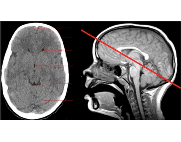 Ct Scan Brainline Brain CT scan 1 β Printable Worksheet