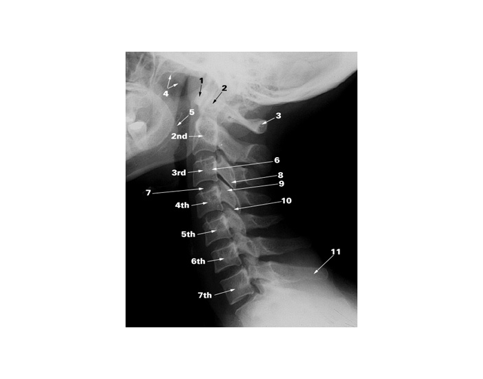 Labeling Radiographs Cervical Spine Lateral Radiograph Labeling Quiz