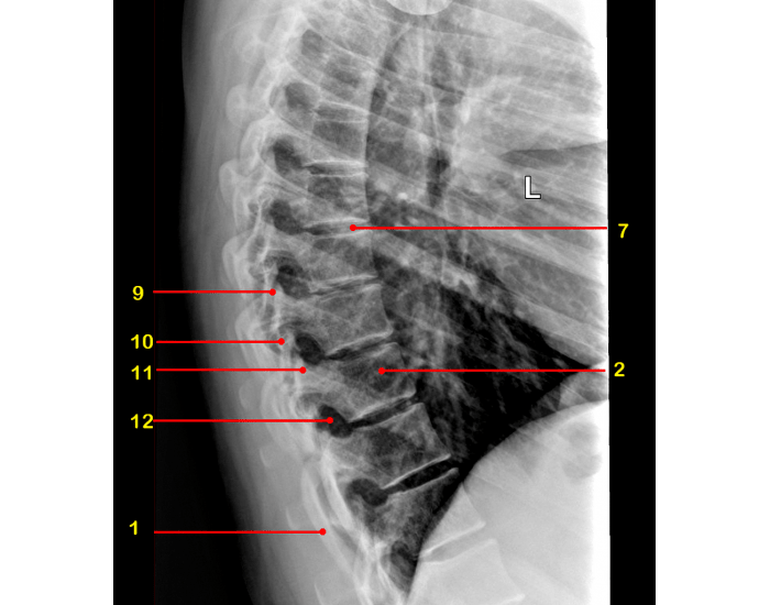 Labeling Radiograph Thoracic Spine Lateral Radiograph Labeling Quiz